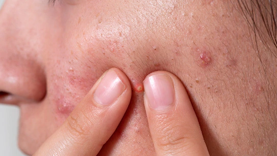 Read more about the article पिंपल्स को कहें अलविदा! अपनाएं ये असरदार घरेलू नुस्खे