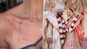 Read more about the article 7 फरवरी को हुई शादी, 10 फरवरी को प्रियंका चोपड़ा की भाभी के शरीर पर पड़ गए छाले: सामने आया चौंकाने वाला वीडियो, फैंस से मांगे इलाज के सुझाव